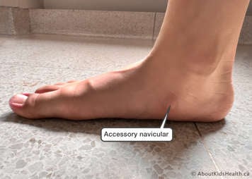 Photo showing a foot with an accessory navicular