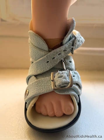 An alternative buckling method to help get a snug fit