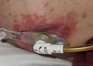 fungal infection around a g tube stoma
