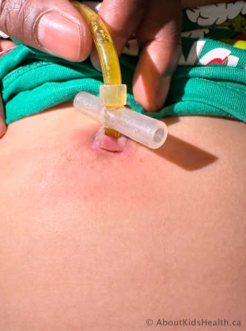 hypergranulation tissue around a G tube