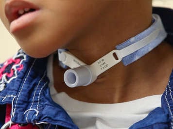 Tracheostomy tube in child's neck