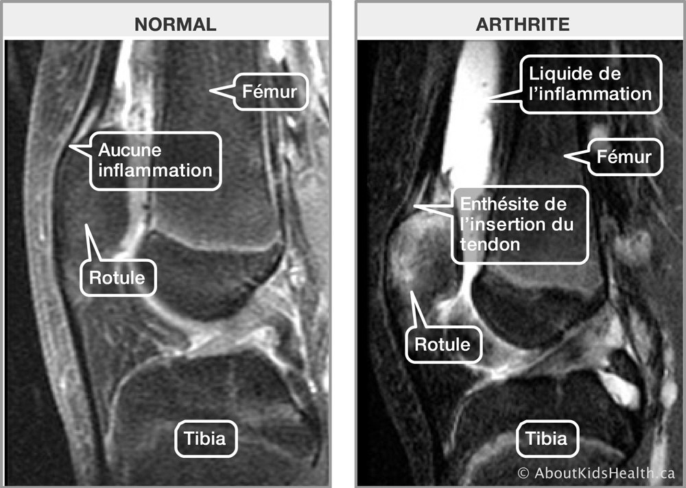 IRM d’une articulation du genou normale et IRM d’une articulation arthritique d’un genou