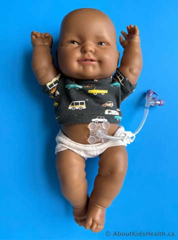 MIC PEG tube in a baby
