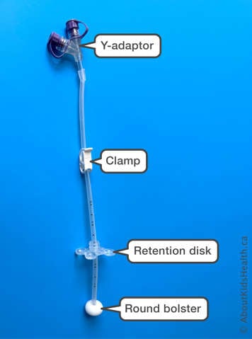 MIC PEG tube showing y-adaptor, clamp, retention disk, and round bolster