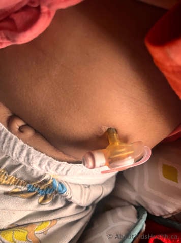 MIC-KEY tube sitting loosely against the stoma