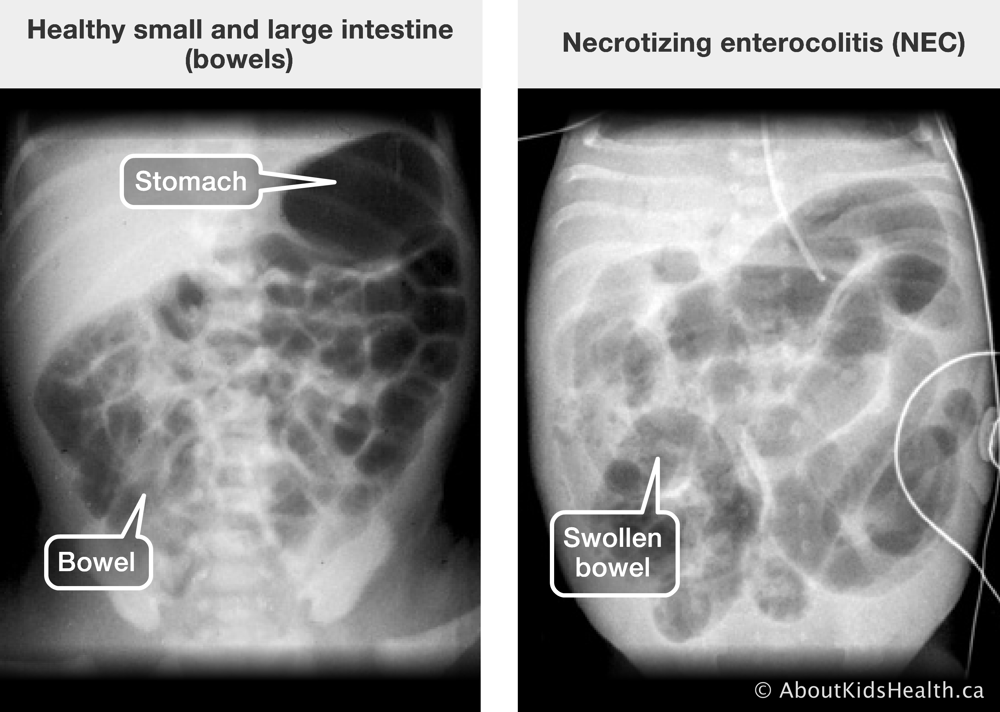 X-ray of healthy small and large intestines and x-ray of swollen bowel due to necrotizing enterocolitis