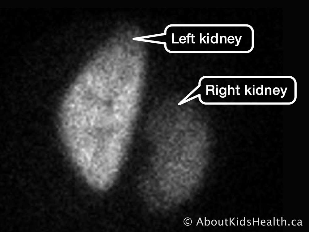 Left and right kidneys in a DMSA renal scan