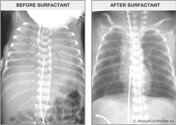 X-ray of lungs of premature baby with RDS shows lungs that appear white beside X-ray of lungs after surfactant, which shows darker lungs