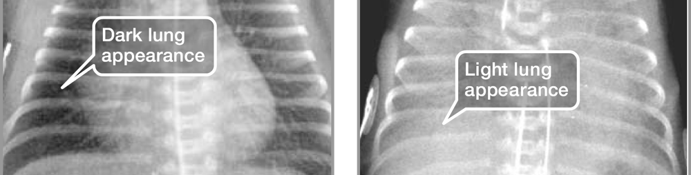 X-ray of normal lung with dark lungs and X-ray of respiratory distress syndrome with light lungs