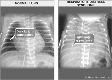 X-ray of normal lung with dark lungs and X-ray of respiratory distress syndrome with light lungs