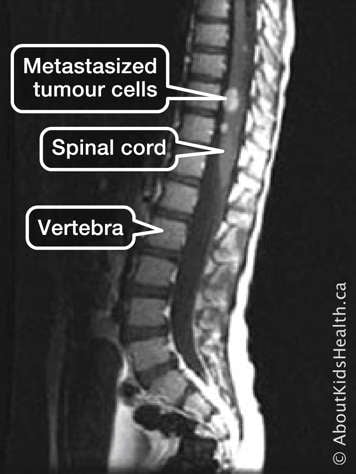 A scan showing the vertebra and spinal cord with metastases