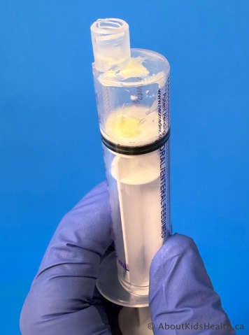 Oral syringe emptied of liquid has sediment from the medication stuck to the end of the plunger and top of syringe