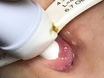 Granulation tissue and crusting around a tracheostomy stoma.