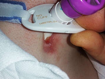 Granulation tissue and redness around a tracheostomy stoma.