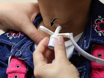 Removing a tracheostomy