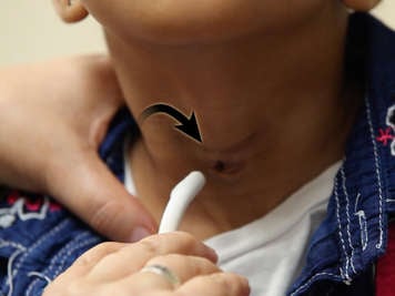 Placing a lubricated tracheostomy tube into a tracheostomy stoma