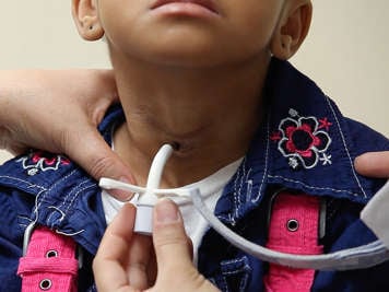 Inserting a tracheostomy tube into a tracheostomy stoma