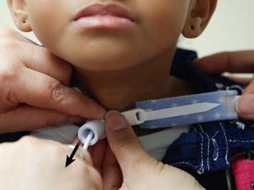 Pulling the obturator out of a tracheostomy tube