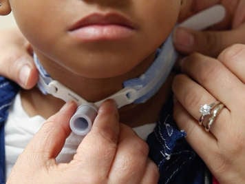 Adjusting tracheostomy ties