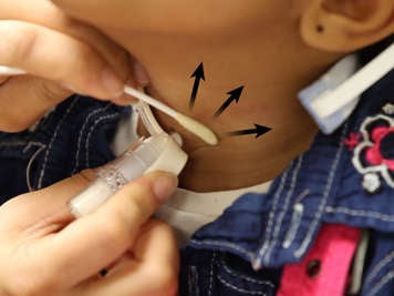 Wiping away from a tracheostomy stoma