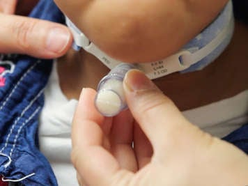 Placing an HME on a tracheostomy