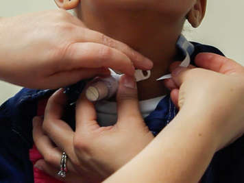 Inserting tracheostomy ties into flange hole.