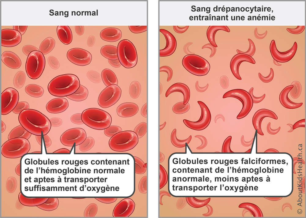 Red blood cells with normal hemoglobin carry enough oxygen&mdash;sickled red blood cells with abnormal hemoglobin carry less oxygen