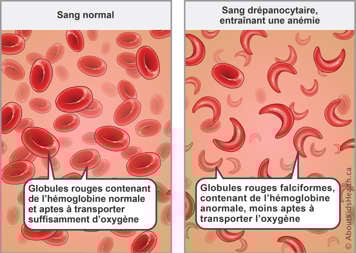 Red blood cells with normal hemoglobin carry enough oxygen—sickled red blood cells with abnormal hemoglobin carry less oxygen