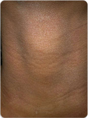 Photo of mild atopic dermatitis