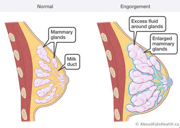 Comparison of a normal breast and an engorged breast