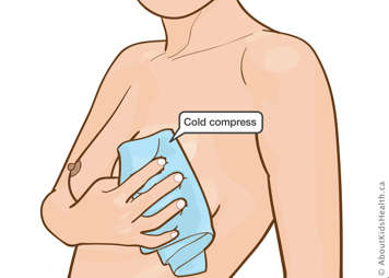 Cold compress on the breast