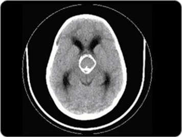 Une tomodensitogramme du cerveau