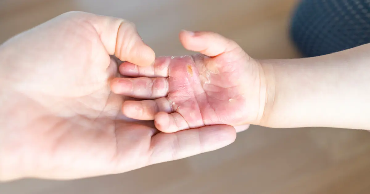 cigarette burn on hand meaning Burns: Types, Symptoms, and Treatments How to Heal a Cigarette