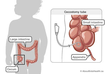 A cecostomy tube in the cecum, which is part of the large intestine