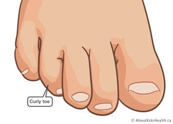 Illustration showing what a curly toe looks like