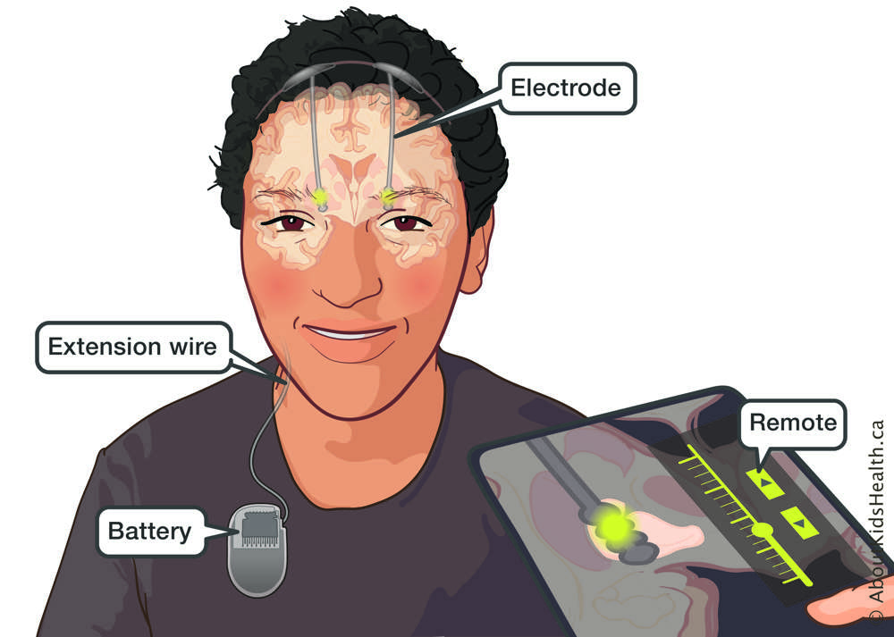 Illustration of child showing placement of electrodes, extension wire and battery with external remote