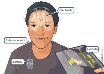 Illustration of child showing placement of electrodes, extension wire and battery with external remote