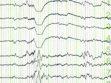 Electroencephalogram patterns