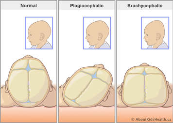 Top view of a normal skull shape, a skull with flattening on one side, and a skull with flattening across the back