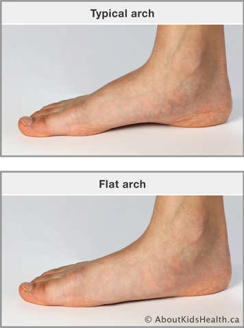Photos comparing a normal foot to a flat foot