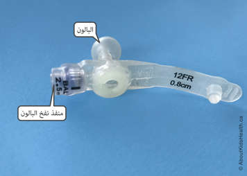 Balloon and balloon inflation port at the end of a G tube