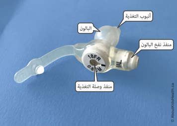 Parts of a Mic-Key low-profile G tube