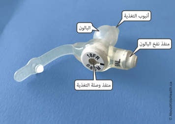 Parts of a Mic-Key low-profile G tube