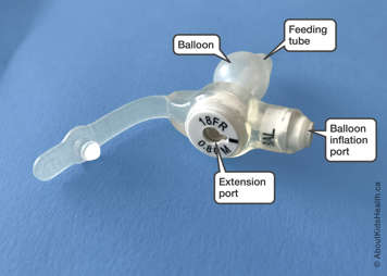 Parts of a Mic-Key low-profile G tube