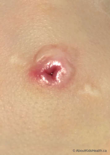 stoma after g tube is removed