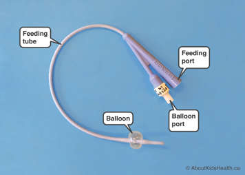 Foley catheter showing feeding tube, feeding port, balloon port and balloon