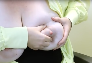 An index finger and thumb pushing backwards into the breast tissue