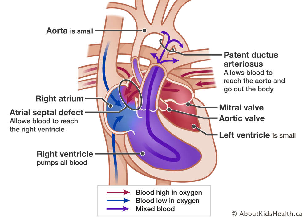 Heart showing small aorta, right atrium, atrial septal defect, right ventricle, small left ventricle, aortic valve, mitral valve, and patent ductus arteriosus.