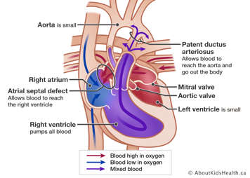 Heart showing small aorta, right atrium, atrial septal defect, right ventricle, small left ventricle, aortic valve, mitral valve, and patent ductus arteriosus.