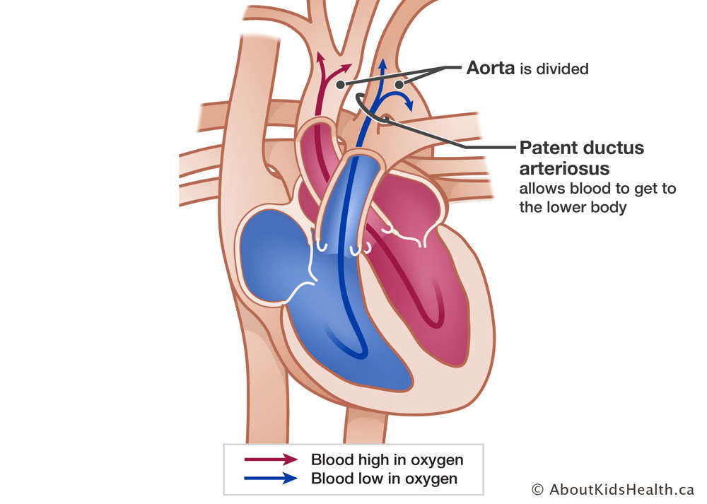 Heart with divided aorta and patent ductus arteriosus that allows blood to get to the lower body